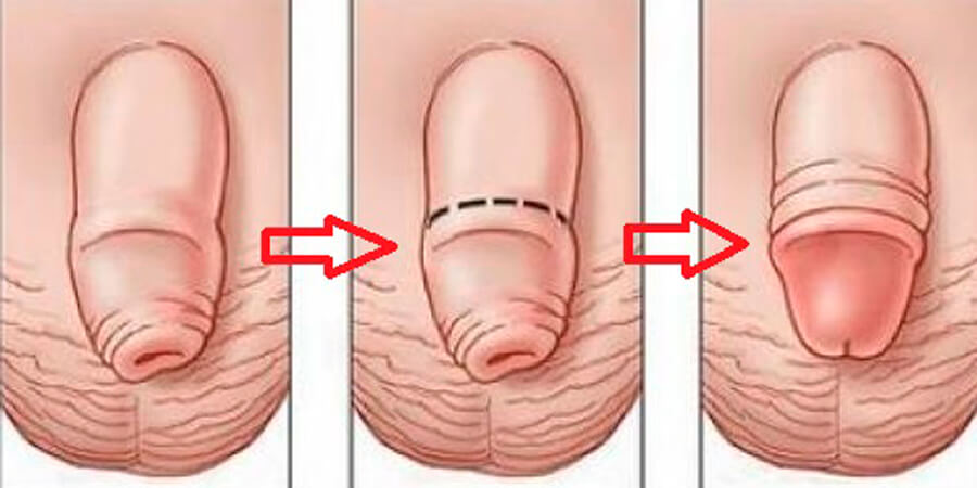 En este momento estás viendo ¿A qué se debe la fimosis?