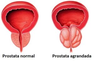 Lee más sobre el artículo Agrandamiento de la próstata: ¿Debería tomar medicamentos?
