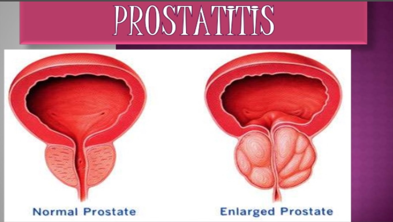 tobramicina para prostatitis la prostata è ereditaria