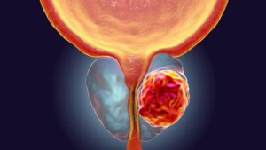Lee más sobre el artículo ¿Cómo se diagnostica el cáncer de próstata?