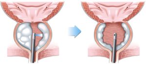 Lee más sobre el artículo Cirugía de próstata con láser de holmio